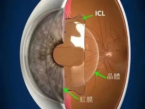 ICL晶体植入手术