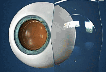 ICL晶体植入术,高度近视可以做近视手术吗