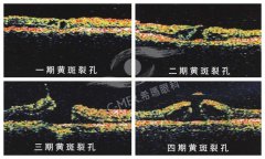 黄斑裂孔对视力损伤大，手术应尽早