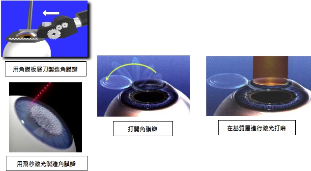 近视矫正手术