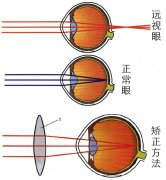 做远视手术的价格是多少？