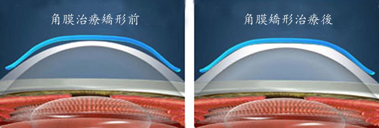角膜塑形镜