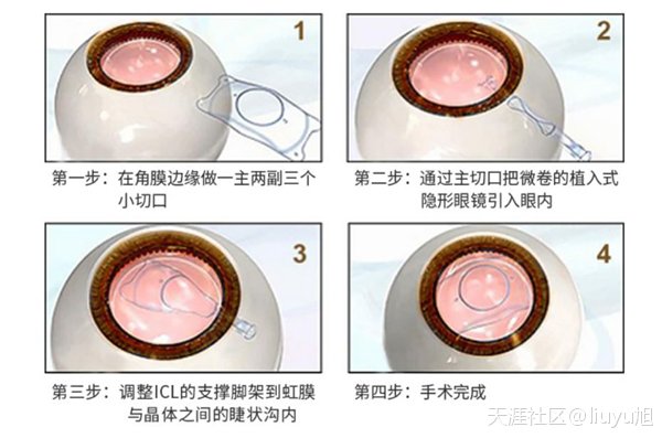 近视手术,ICL晶体植入术,珠海近视医院