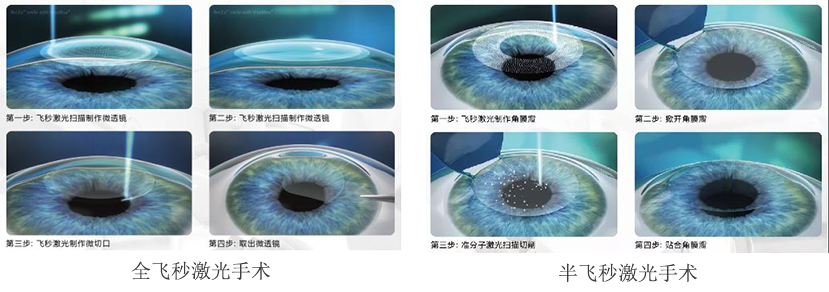 珠海全飞秒手术多少钱,珠海icl手术多少钱,近视手术,珠海近视医院