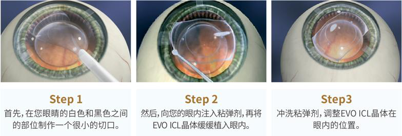 全飞秒和晶体手术哪种好
