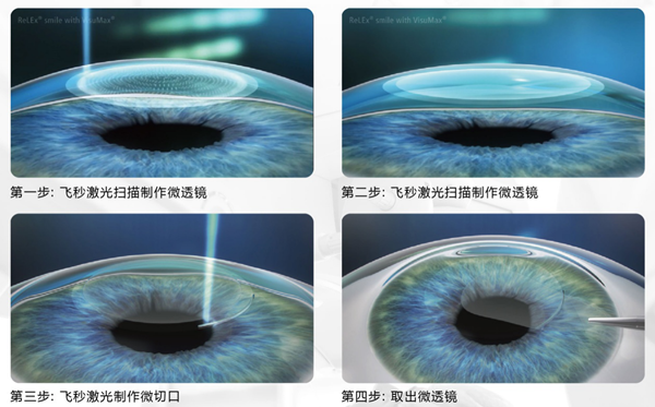 近视手术,ICL晶体植入手术,全飞秒激光近视手术