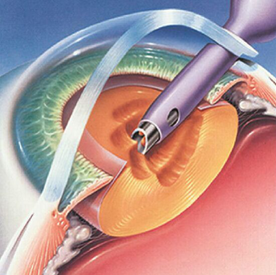 珠海近视手术,ICL晶体植入术,珠海近视手术哪家好