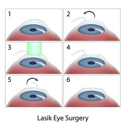 近视激光手术,LASIK手术后近视能恢复吗